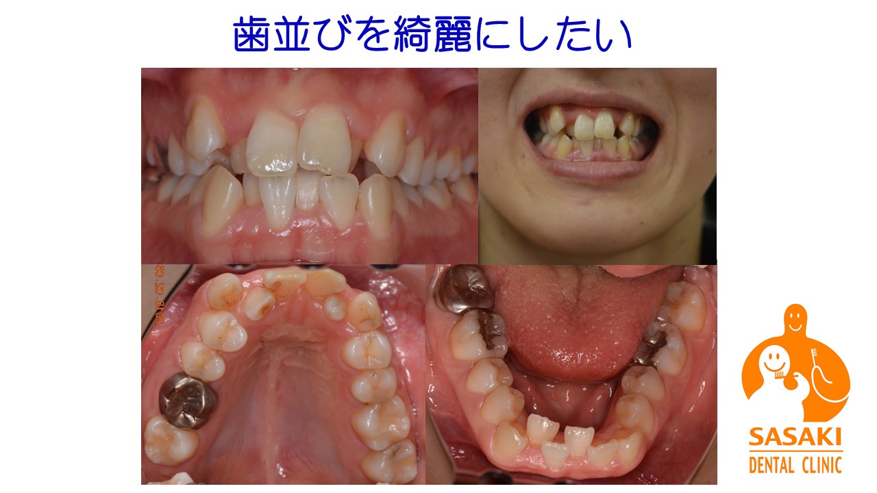 乱喰い歯（ガタガタ)の歯並びを矯正した２０代女性の治療例