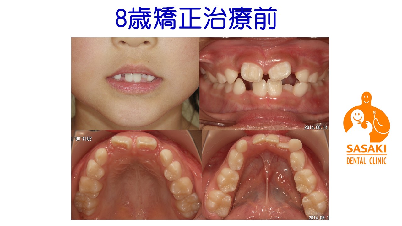小児矯正で綺麗な歯並びになった女子（小学3年～中学1年までの期間）