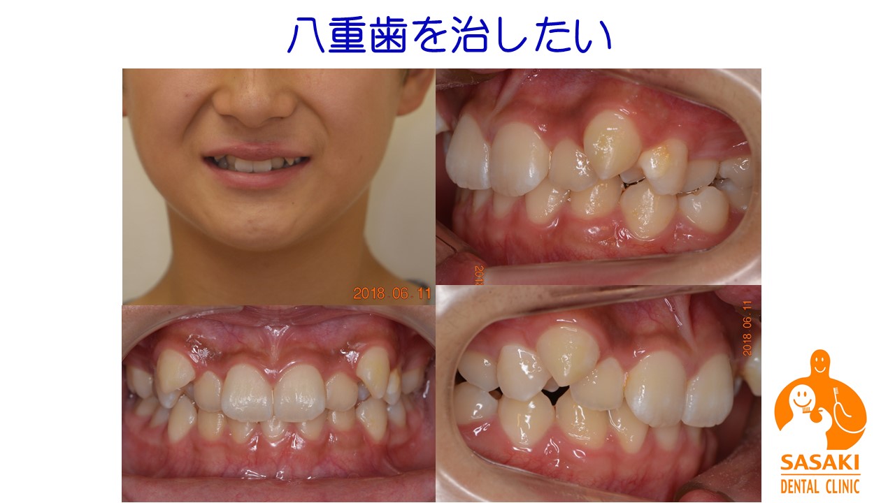 中学生の八重歯を１年５か月で綺麗な歯並びに