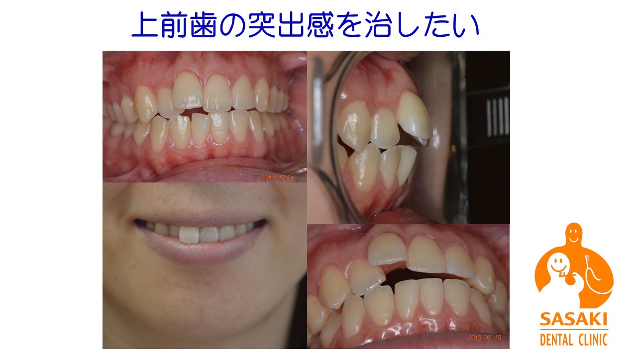 上の前歯の突出を１０か月程で改善した２０代女性の笑顔